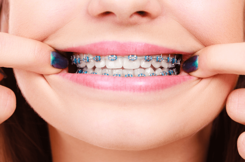 How to Tell If You’re Having an Orthodontic Emergency