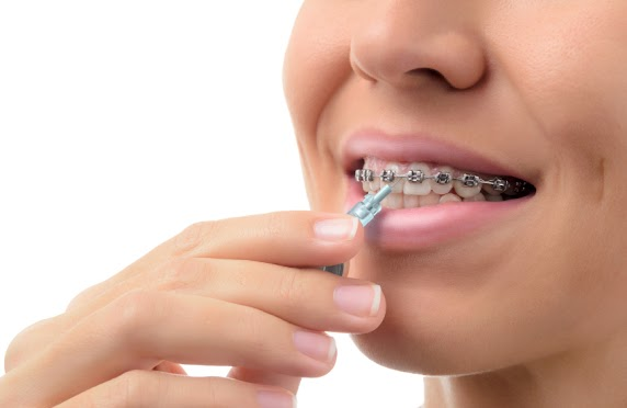 This is the image for the news article titled How to Take Care of Braces at Home