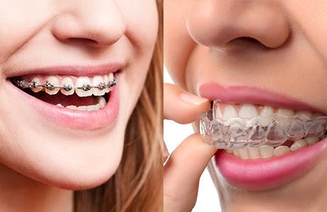 Traditional Braces vs. Invisalign—Which One is Right for You?
